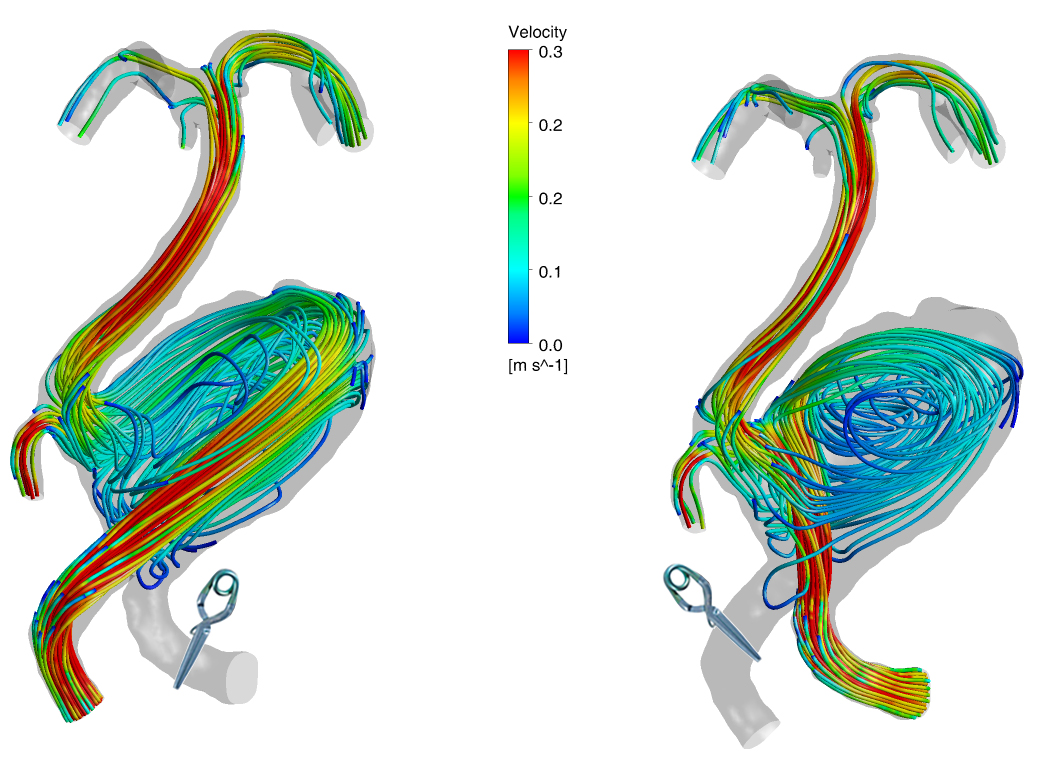 Research Cardiovascular Flow Modeling Laboratory Purdue University